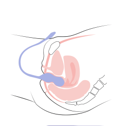 Perifit Care+ Sonde périnéale nouvelle génération  - 5